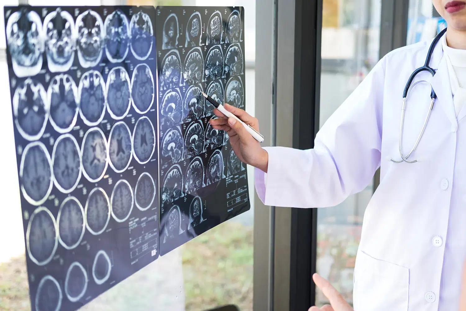 Doctor pointing at brain MRI film scans mounted on a window during a medical evaluation.
